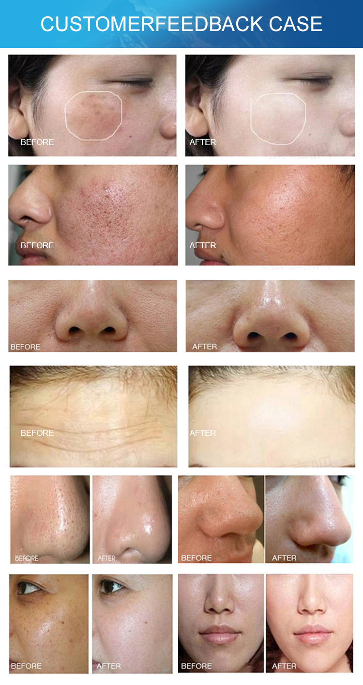 Home Facial Microderm Beauty Therapy Machine Acne Scar Treatment 7 Inch Screen