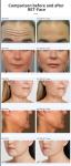 Vertical Magnetic Facial Ems rf Skin Rejuvenation Lifting Skin Tightening