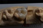 Customizable Ceramic Inlays And Onlays In Dentistry Restoration