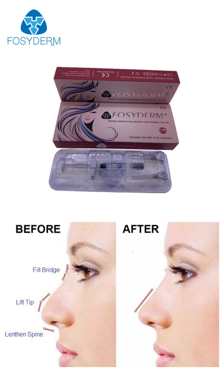 Fosyderm HA Dermal Filler Gel Injectable Nose Lips Filler 24mg/ml