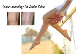 Quality 1064nm Spider Vein Removal Machine 532nm KTP Non Invasive Laser Treatment wholesale