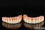 Natural-looking Aesthetics Zirconia Hybrid Bridge With High Durability And