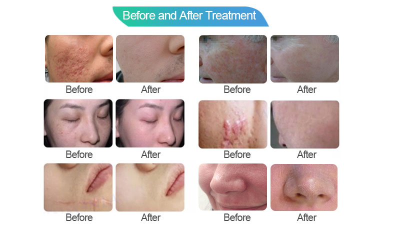 skin rejuvenation fractional co2 laser remove acne dark spots 100w co2 laser machine q switched picosecond laser beauty