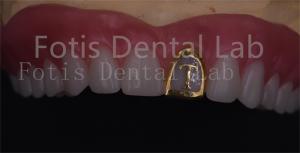 Quality OEM Natural Full Acrylic Denture Ivoclar Teeth Stain Resistance wholesale