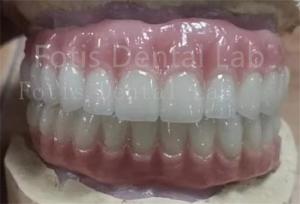 Quality Precise Fit Ivoclar Teeth Acrylic Complete Denture Stain Resistant wholesale