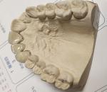 Metal Ceramic Good Fitness PFM Dental Crown