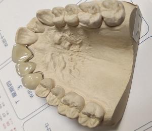 Quality Metal Ceramic Good Fitness PFM Dental Crown wholesale