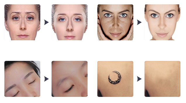 Professional Laser Tattoo Removal Machine Pigmentation Removal Picosecond Laser
