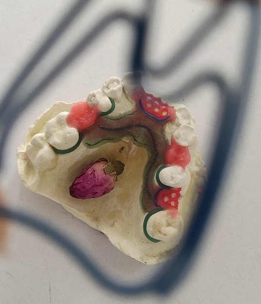 Cr Co Partial Denture Metal Framework