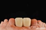 Multilayer PMMA Polymethyl Methacrylate For Dental Restorations