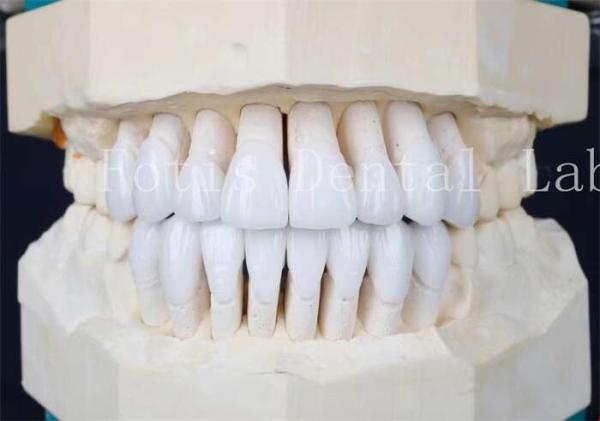 Adhesive Bonding Cement and High Strength Synthetic Laminate Veneers The Perfect