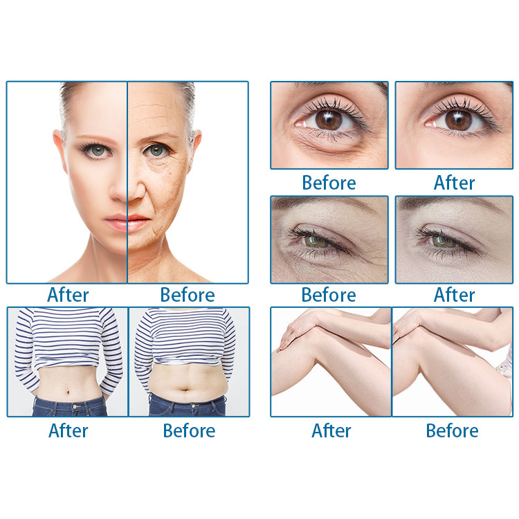 Skin Rejuvenation HIFU 4D Machine , SMAS Cartridges Firming HIFU Treatment Machine