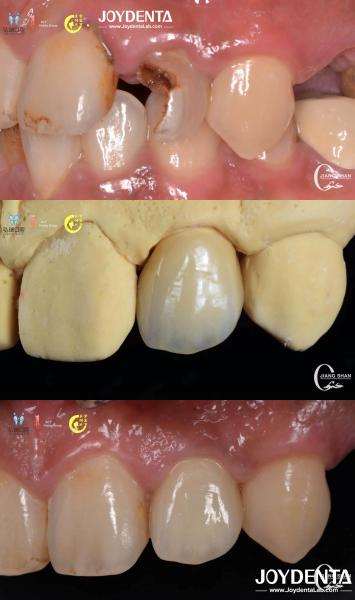 Lifelike Tooth Appearance Zirconia Bridges Dental Restoration Wear Resistant