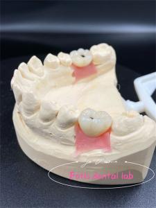 Quality Customization Titanium/Ziconia/PFM Dental Lab Crowns Comfortable wholesale