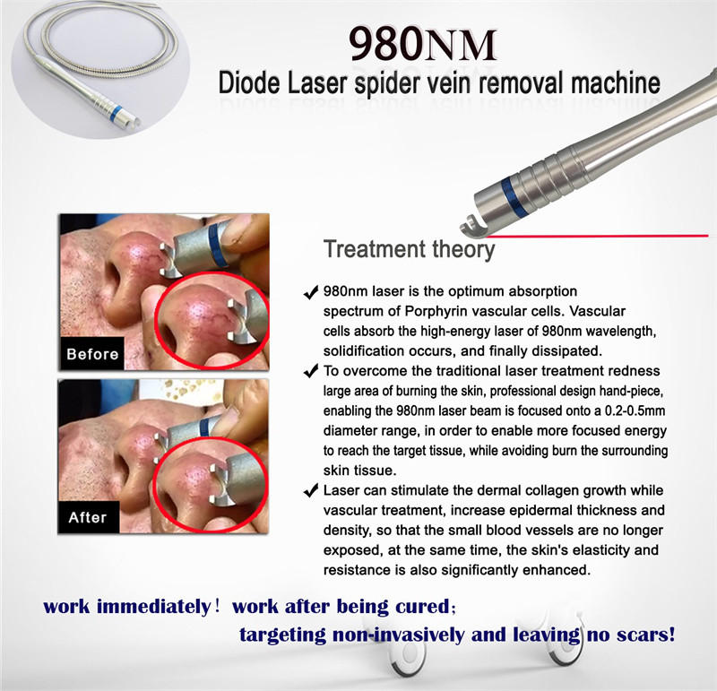Portable Diode 980nm Laser Spider Vein Removal Machine / Vascular Laser Machine