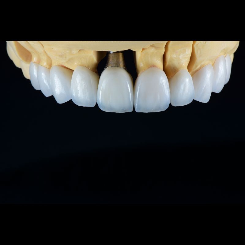 Fixed Restorations Full Arch Zirconia Implant Bridge Denture Teeth