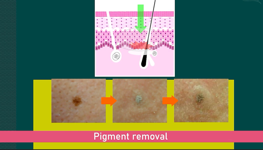 Long Pulse Nd YAG Laser Hair Removal Machine Portable For Commercial