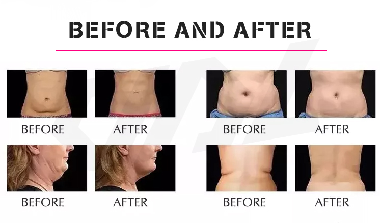 80K Vacuum Rf Slimming Weight Loss Body Slimming Machine Skin Tightening Wrinkle Removal 3D Cavitative Machine