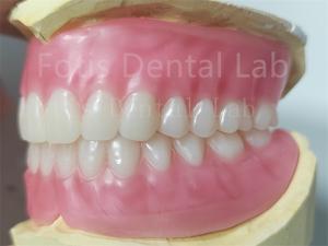 Quality OEM Full Upper And Lower Acrylic Denture Stain Resistance Natural Color wholesale