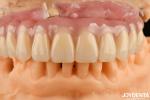 Fast Drying 5 Minutes Acrylic Teeth Finish For Dental Tooth Restoration