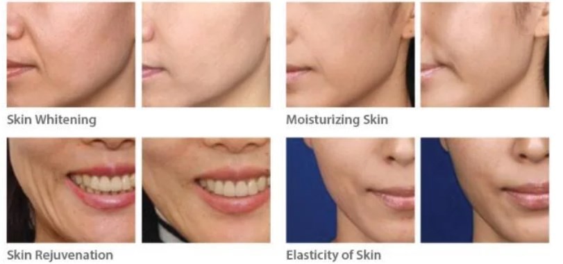 Anti Aging Skin Booster PDRN Baby Needle Injectable Mesotherapy