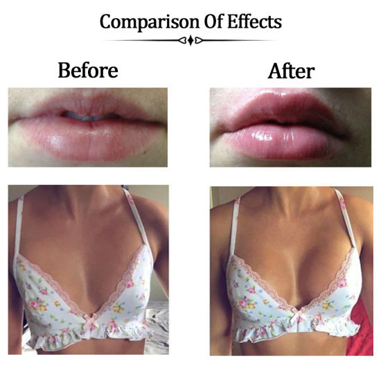 Safe And Effective Hyaluronic Acid Breast Filler For Breast Buttock Augmentation