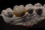 Precise Ceramic Dental Inlays And Onlays Restoration Stain Resistance