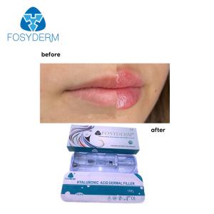 Quality Fosyderm Dermal Lip Fillers 1ml Hyaluronic Acid Injection For Lip Enhancement wholesale
