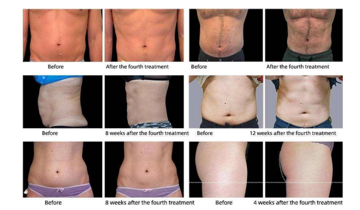 Non Invasive Body Sculpting Machine , Magnetic Muscle Stimulation Machine