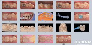 Quality Adults Children Porcelain Ceramic Dental Inlay Restorative for Damaged Teeth wholesale