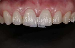 Quality High Translucency Dental Lab Laminate Veneers for Natural and Polishing wholesale