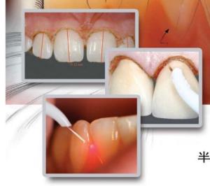 Quality Dental Tooth Whitening Machine dental laser teeth whitening wholesale