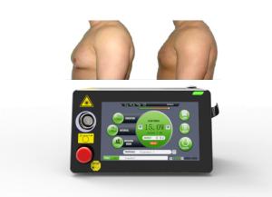 Quality 16W Laser Lipolysis Machine Gynaecomastia Treatment Minimally Invasive wholesale