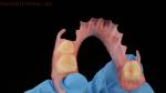 3D Print Model Dental TCS Valplast Flexible Partial Dentures Pink / Dark Color