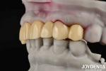 High Transparency PMMA Dental Material Natural Color Lifelike Aesthetics