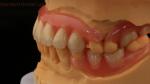 3D Print Model Dental TCS Valplast Flexible Partial Dentures Pink / Dark Color