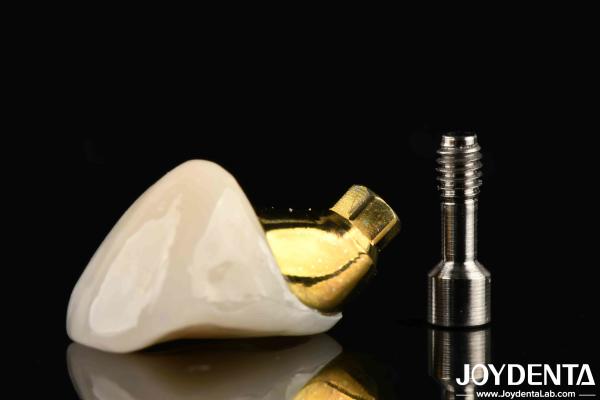 Long-Lasting Implant Crown And Bridge For Restoring Missing Teeth Suitable For