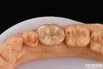 High Durability Dental Inlay Onlay Composite Natural Looking Appearance