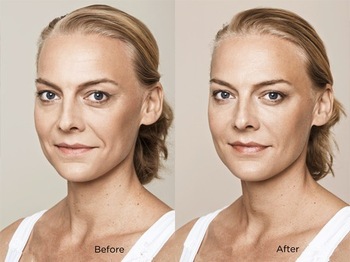 Fosyderm Hyaluronic Acid Forehead Wrinkles 1ml 2ml Injectable Filler Type