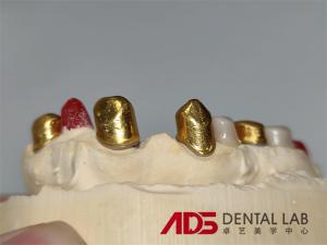 Quality Dental Telescopic Crowns Prosthesis In Dentistry Customizable wholesale