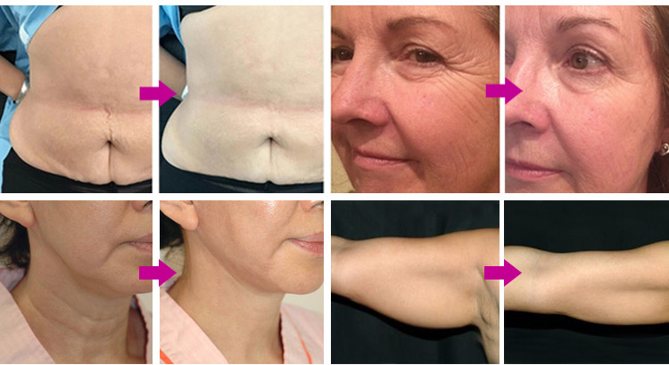 Skin Rejuvenation HIFU 4D Machine , SMAS Cartridges Firming HIFU Treatment Machine
