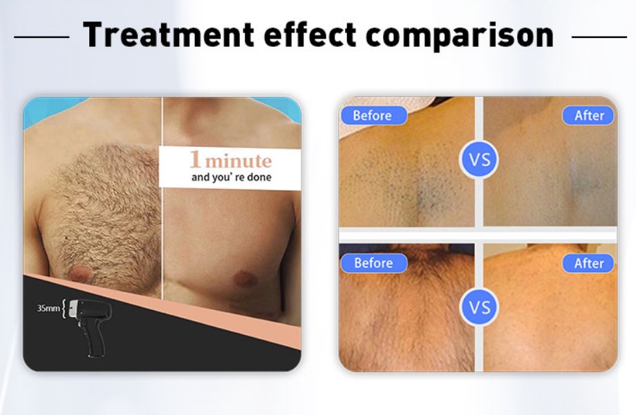 Stationary Style 808nm/755nm/1064nm Diode Laser Hair Removal Machine for Professional