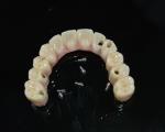 Zirconia Dental Crown: Natural-looking Teeth, Durable & Secure