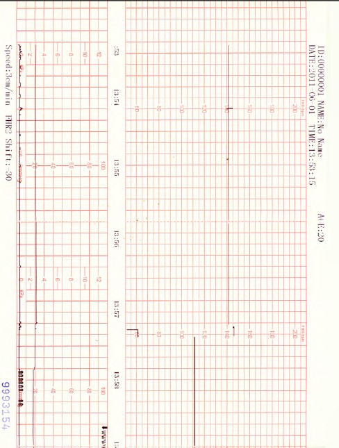 ctg machine maternal and fetal doppler monitor for TOCO,FHR,FM DM002