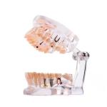 32 Tooth Full Month Implant Disease Teeth Model Clear Design Dental Pathology