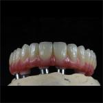 Fixed Restorations Full Arch Zirconia Implant Bridge Denture Teeth