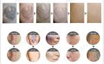 Q Switch ND Yag Laser 1064nm 532nm Pigment & Tattoo Removal Machine Carbon
