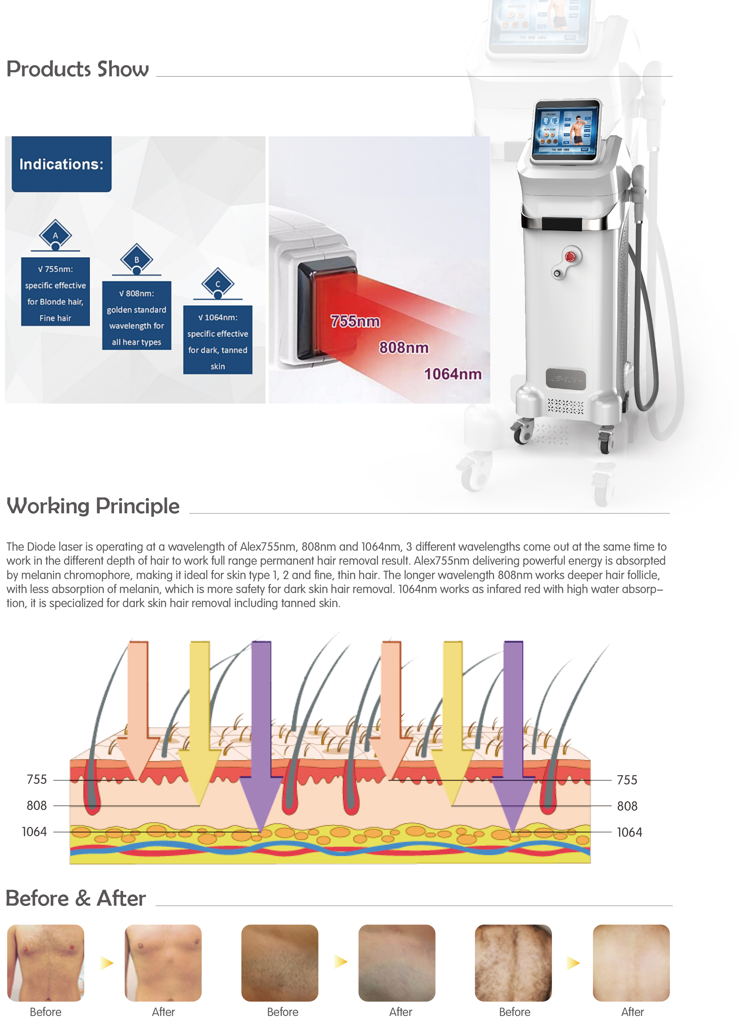 755,808, 1064nm three wave length permanent body hair removal diode hair removal