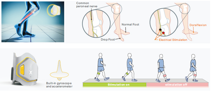 Health Assistive Foot Drop Walking Devices