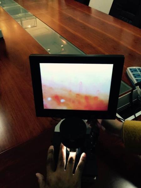 Hospital Microcirculation Microscope Nailfold Video Capillaroscope Detection